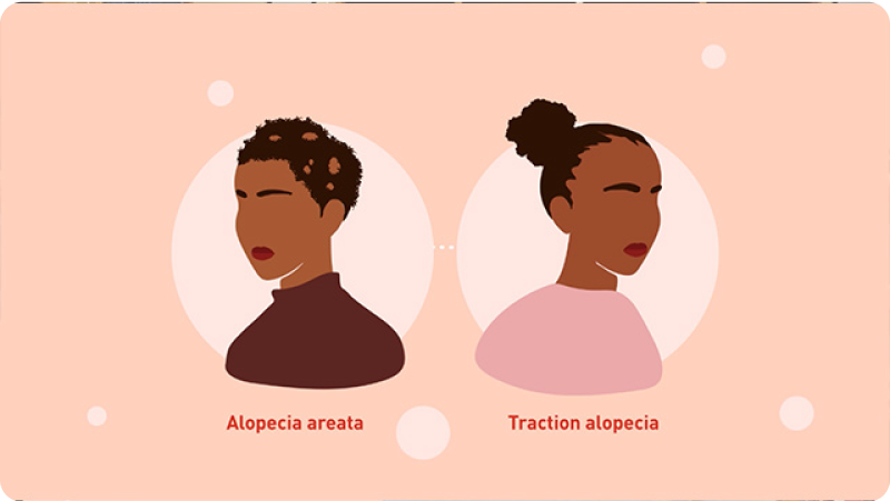 Video thumbnail: two women of color with alopecia areata