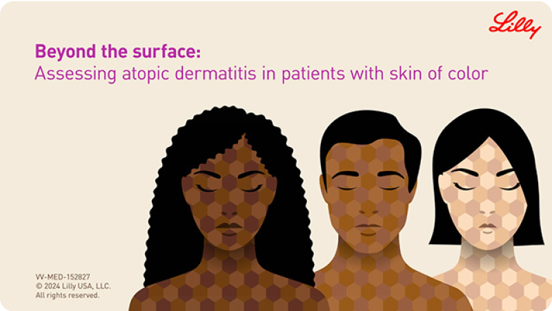 Video thumbnail: three patients of color with atopic dermatitis