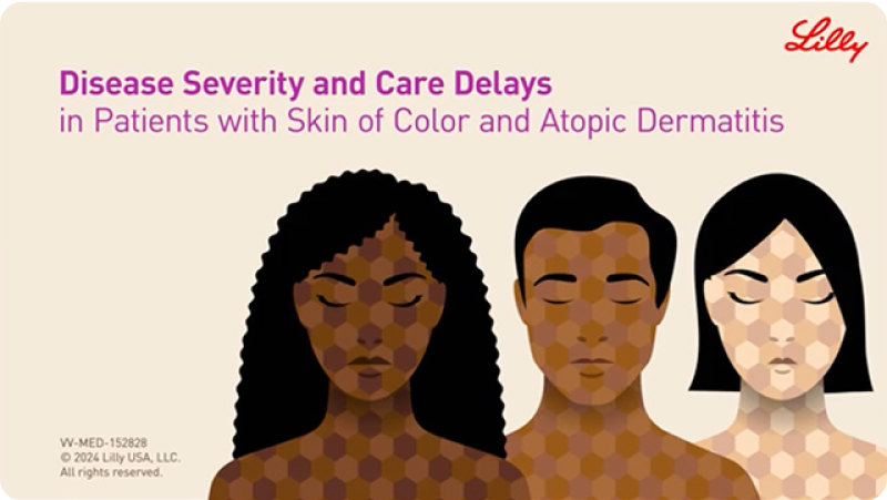 Video thumbnail: three patients of color with atopic dermatitis