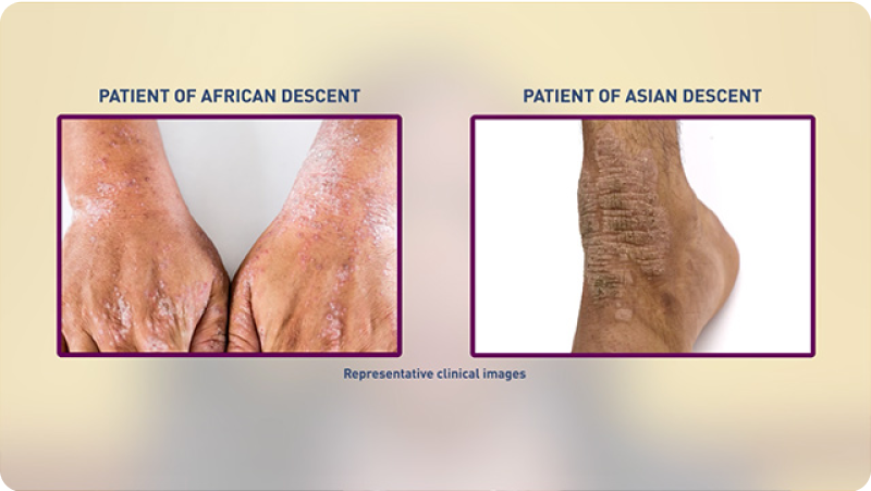 Video thumbnail: hands of patient of African descent and ankle of patient of Asian descent with atopic dermatitis